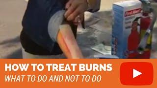 How To Treat Burns 2nd degree 3rd degree burns