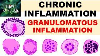 INFLAMMATION Part 9 Chronic Inflammation - GRANULOMATOUS INFLAMMATION