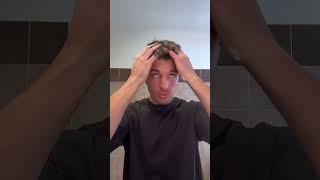 MY HAIR ROUTINE AFTER HAIR TRANSPLANT