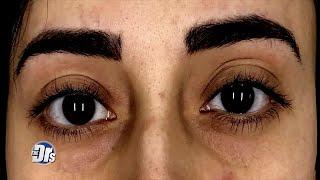 See the Results of Woman’s Injections to Combat Her Dark Circles