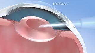 Hanita Lenses - cataract surgery