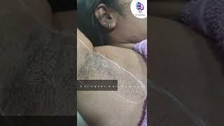 Get Rid of under-arm hair by Laser Hair Removal Treatment  VJ’s Cosmetology Clinic