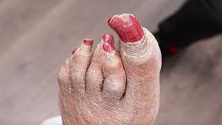 BEST NAIL TRIMMING OF 2022? ***SUPER THICK LONG TOENAIL***