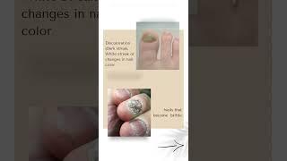 ABNORMALITIES OF THE NAIL  Cutis Hospital Bangalore  Nail Care  Nail Treatment  Best Nail Expert