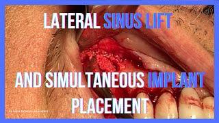 Advanced Dental Procedure Lateral Sinus Lift with Simultaneous Implant Placement  + Online Courses