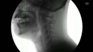 My X Ray swallows