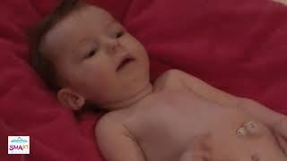 Learn to Spot the Warning Signs of SMA – Floppy Baby Video 5