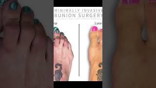 Revolutionary Minimally Invasive Bunion Surgery A Step Towards Pain-Free Feet