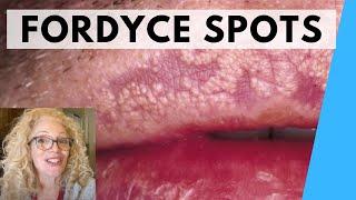 SYRINGOMA VS FORDYCE SPOTS  NATURAL REMEDIES