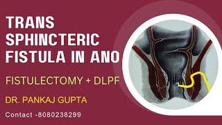 Trans sphincteric complex Fistula in ano managed by DLPF + Fistulectomy Dr.Pankaj GuptaAkola.