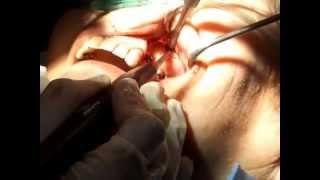 Sinüs lifting ve Box Technique - Box teknik ile implant tedavisi - Tanfer Klinik