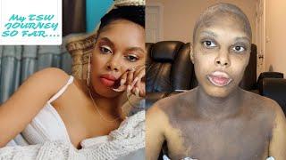 My TSW Journey so far  5 Months  ECZEMA Awareness