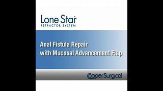 CooperSurgical Lone Star Fistula Repair