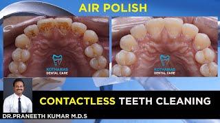 Advanced contactless teeth cleaning