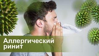 Аллергический ринит  Аллерголог Иммунолог Парвиз Азизов