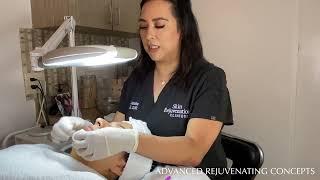 Teen Acne Facial Extractions Glycolic Peel & Microdermabrasion