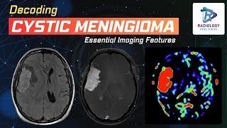 Decoding Cystic Meningioma  Dr. Umamaheswara Reddy .V