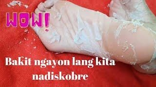 Chemical Foot Peel solusyon sa may mga kalyo sa paa na katulad ko