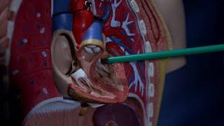Copy of Doctors explore breakthrough heart valve procedure