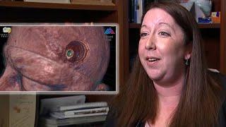 Woman relieved after brain tumor turns out to be parasite