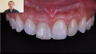 Dr. Ventseslav Stankov Immediate Implant Combined with Crown Lengthening