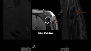 MRI - ELBOW FABS POSITION