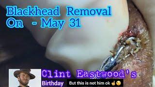 Blackhead removal on May 31st #blackheadremoval #blackheads @Dr.AMAZINGSKIN