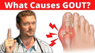 What Causes GOUT? Meat Doesnt Cause Gout 2024