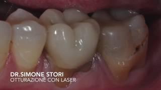 Otturazione con LASER ad Erbio