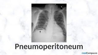 Pneumoperitoneum Chest X-Ray Signs  High Yield  Radiology