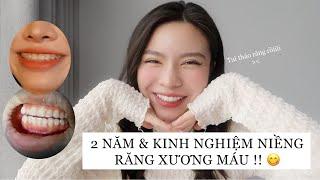 Kinh nghiệm tạo khuôn răng đẹp trước khi tháo niềng  Nhật ký niềng răng kết thúc  CharmBeauty