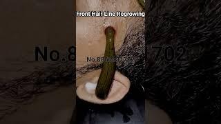 Front hair line regrowingLeech TherapyGujarat Hijama Therapy#leechtherapy #leeches #shorts