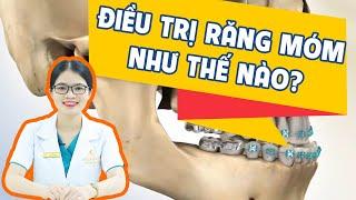 Niềng răng móm như thế nào? có đau không?