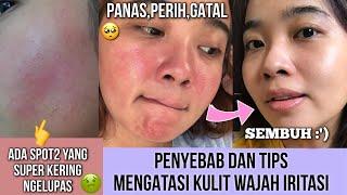 PENYEBAB DAN TIPS ATASI KULIT WAJAH IRITASI PANAS PERIH GATAL MENGELUPAS