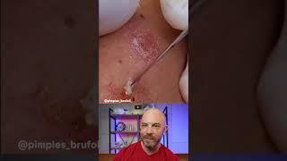 Please dont play with your cysts #dermreacts #doctorreacts #pimplepopper #cystpop