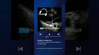 LVOTO due to Systolic Anterior Motion of the Mitral Valve #EMRAP #EM #EmergencyMedicine