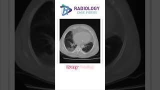 Viral Pneumonia #Dr. Umamaheswara Reddy