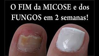 O FIM DAS MICOSES E FUNGOS NAS UNHAS EM 2 SEMANAS Feat.  Kátia Rosenberg por Joyce Vignochi