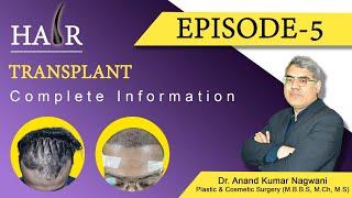 Natural Looking Hairline Transplant at Cosmo Aid  Dr. Anand Kumar Nagwani  FUT & FUE Transplant