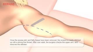 Arm Lift Animation - Boerhaave Medical Centre