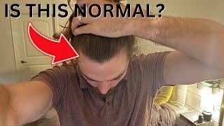 AM I BALDING? Difference Between Hair Loss & Shedding