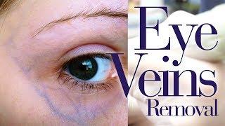 YAG LASER - Eye Treatment used to eliminate Veins under the eyes