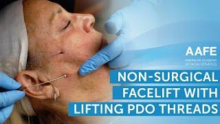 Non-Surgical Facelift with Lifting PDO Threads  AAFE