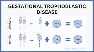 Gestational Trophoblastic Disease Molar Pregnancy Explained