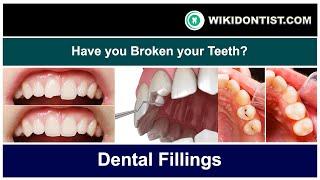 Have you Broken your Teeth?..  Dental Fillings  Video by Dr.Thomas Nechupadam