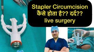 ZSR Circumcision live operation  How stapler circumcision is done  phimosis treatment 