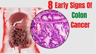 Top 8 Early Warning Signs Of Colon Cancer - Colon Cancer First Stage