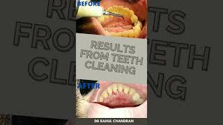 #shorts Why Cleaning Teeth at the Dentist is Important???