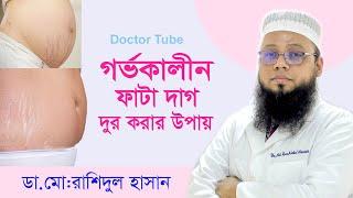 গর্ভকালীন ফাটা দাগ দূর করার সহজ উপায়  How To Reduce Stretch Marks  Bangla Tips  Doctor Tube