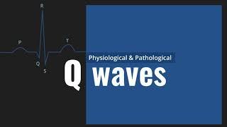 Physiological and Pathological Q waves #ECG Interpretation